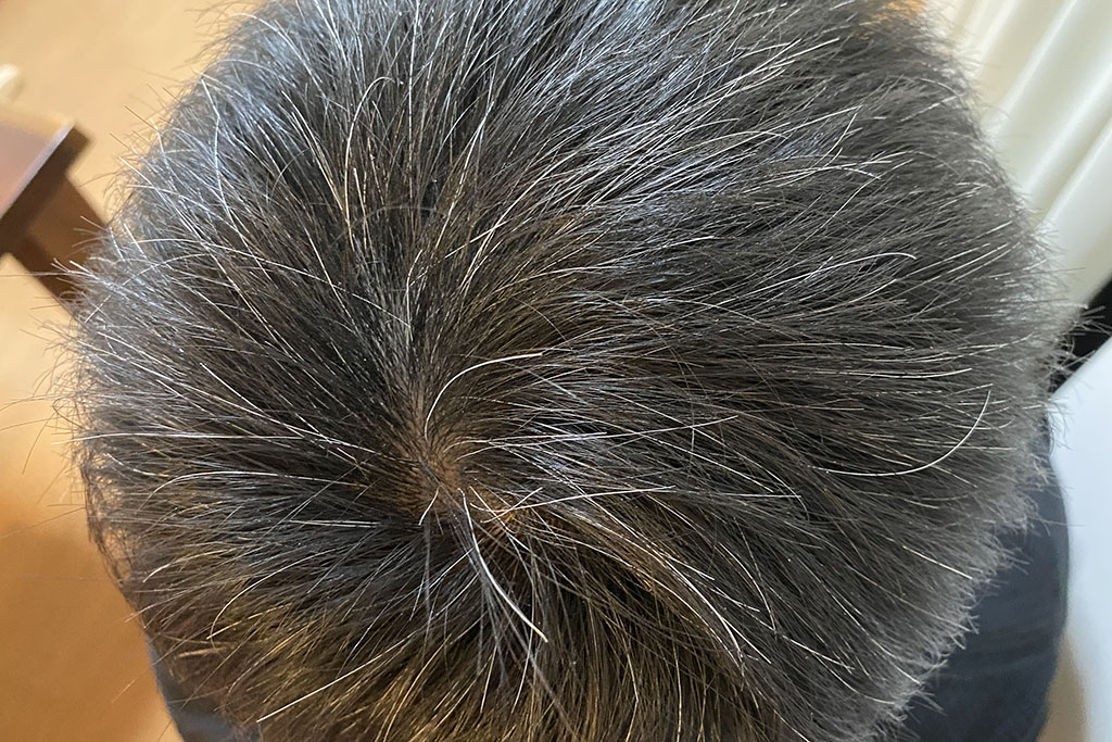 Before(頭頂部)